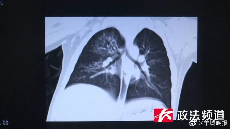 长沙2岁男童掉入运转洗衣机肺部感染10种细菌(图1)