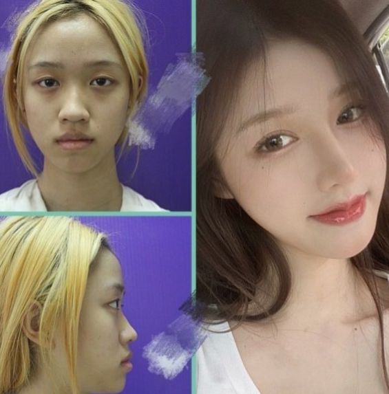 整形价格多少钱？做次整形到底需要多少钱？2022年全国整形价格表查询？双眼皮价格表？隆鼻价格表？吸脂价格表？(图9)