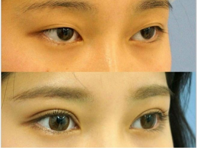 整形价格多少钱？做次整形到底需要多少钱？2022年全国整形价格表查询？双眼皮价格表？隆鼻价格表？吸脂价格表？(图3)