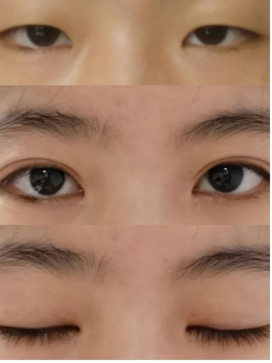 整形价格多少钱？做次整形到底需要多少钱？2022年全国整形价格表查询？双眼皮价格表？隆鼻价格表？吸脂价格表？(图4)